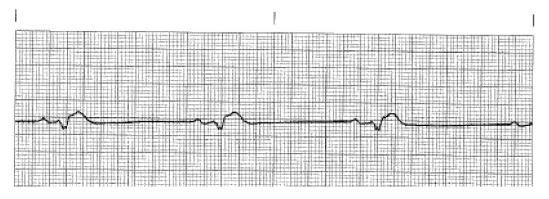 EKG Test - ProProfs Quiz
